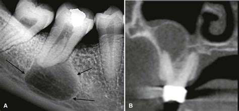 21. Cysts | Pocket Dentistry