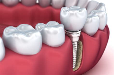 Dental Implants - Procedure, Advantages and Cost