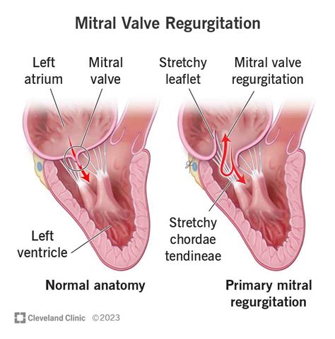 Mitral Valve Regurgitation: Symptoms & Causes