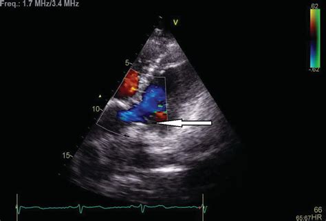 Doppler echocardiogram of the preoperative pulmonary valve showing... | Download Scientific Diagram