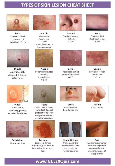 MEDizzy - Types of Skin Lesion Cheat Sheet | Nursing school survival, Nursing school tips, Home ...