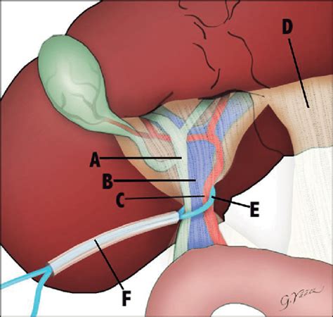 Representación de la Maniobra de Pringle. A: vía biliar; B: vena porta;... | Download Scientific ...