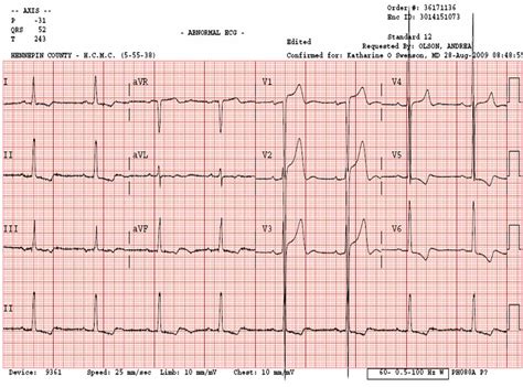 Dr. Smith's ECG Blog: Left Ventricular Hypertrophy May Result in Profound ST Elevation