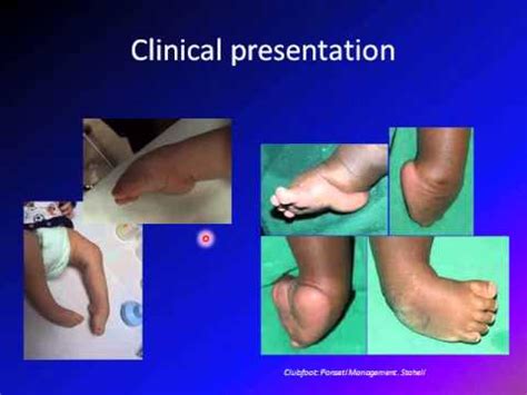 clubfoot / talipes equinovarus / TEV - YouTube