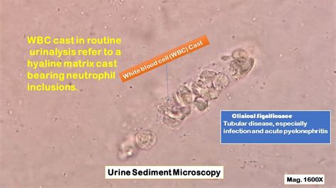 Wbc Casts In Urine