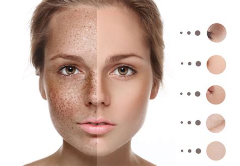 Types of Pigmentation and what caused this? | skinmatters