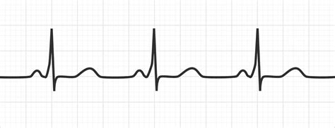 The PR Interval | ECG Basics - MedSchool