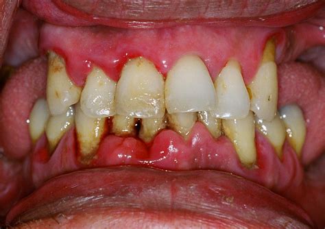 Early Signs from Gingivitis to Periodontal Treatment | Precious Smile