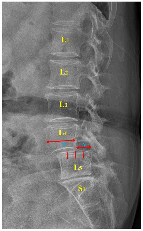 Spondylolisthesis X Ray