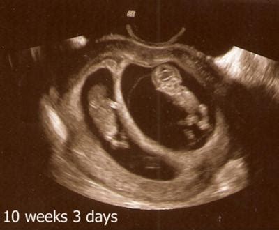 Twins Ultrasound -10 Weeks