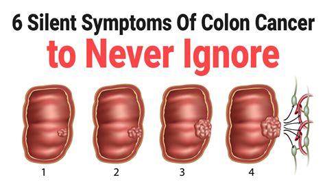 6 Silent Symptoms Of Colon Cancer to Never Ignore - Health Queen