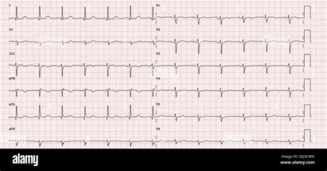 Normal ecg hi-res stock photography and images - Alamy