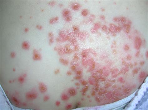 Rash on back | MDedge Family Medicine