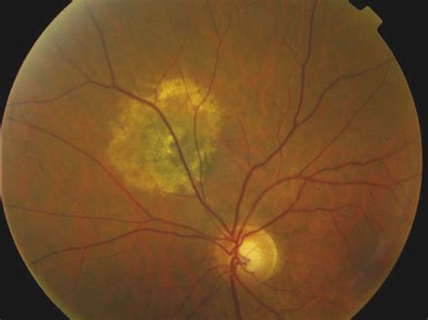 26 Choroidal Nevus and Melanoma | Ento Key