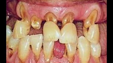 Easy Preventable Dental Disorder - Cervical Abrasion.