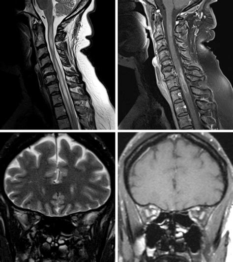 Neuromyelitis Optica (NMO) | The Neurosurgical Atlas