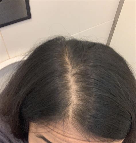 Androgenic alopecia? How bad is this?! : r/Hairloss