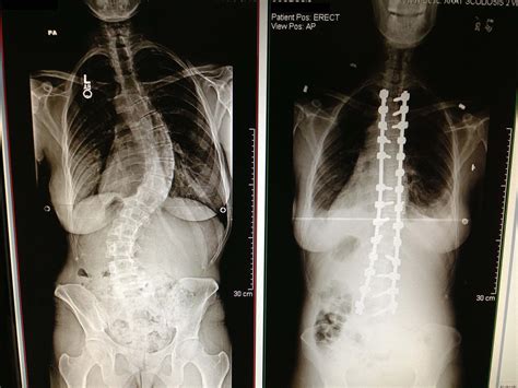 scoliosis surgery | The Stork and the Beanstalk