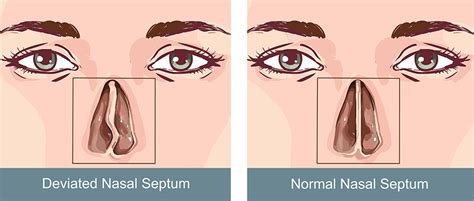 Deviated septum- symptoms, treatments and causes | healthdirect