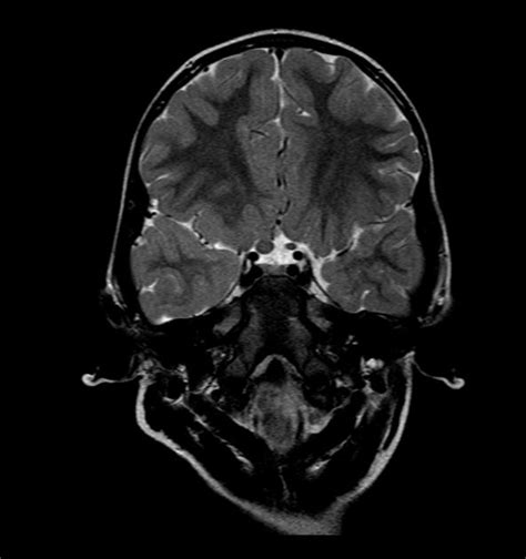 Optic nerve glioma MRI - wikidoc