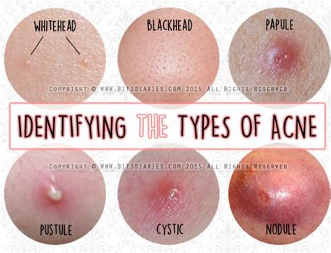 DIFFERENT TYPES OF ACNE - ALL ABOUT ACNE