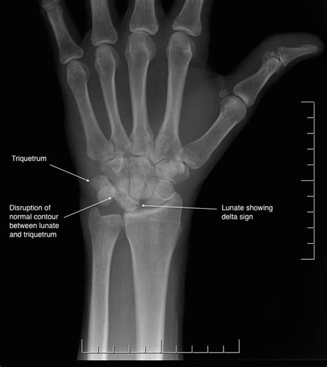 Ulnar Collateral Ligament Wrist Mri