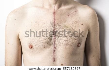 Scar Open Heart Surgery Where Sternum Stock Photo 557182897 - Shutterstock