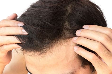 Treatment Options for Androgenic Alopecia - Harbor Compounding