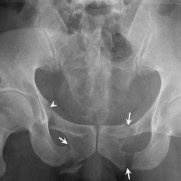 Patients with pelvic fractures according to each pelvic bone involved. | Download Scientific Diagram