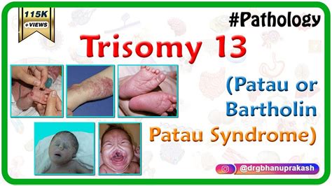 Trisomy 13 (Patau or Bartholin-Patau syndrome) - Causes , Diagnosis , Treatment - YouTube