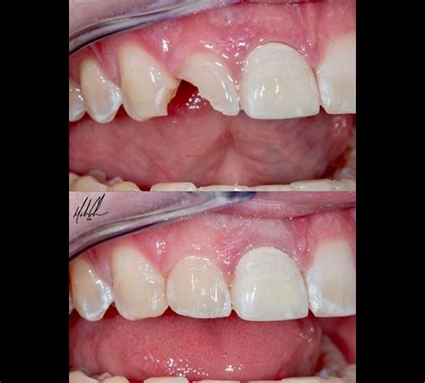 Smile Gallery | Before & Afters | Infinite Smiles Dentistry