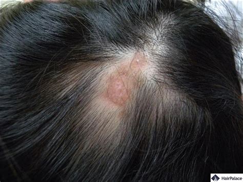 Lupus Hair Loss | Causes, Symptoms and Treatment Options