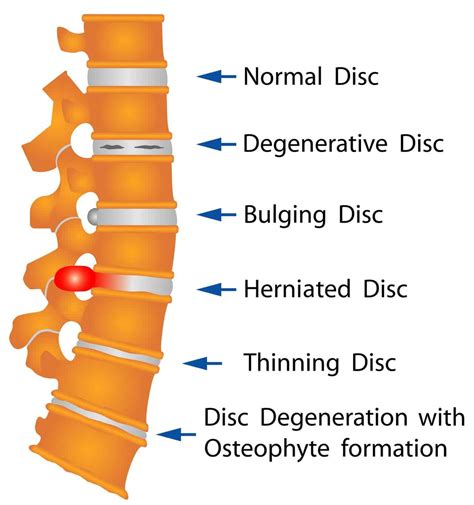 What are the Causes and Symptoms of a Disc Herniation? - Advanced Chiropractic Spine & Sports ...