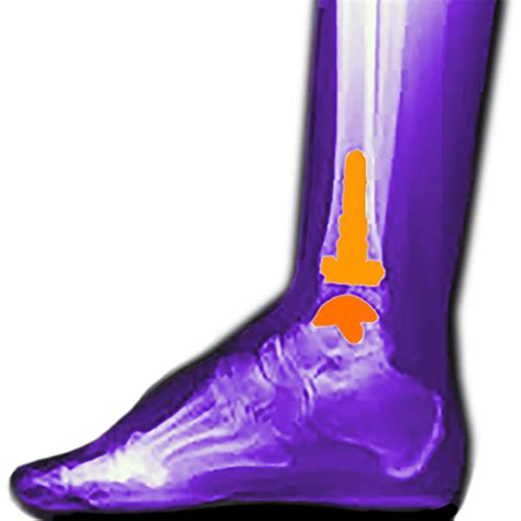 Arthroplasty - Nisantasi FootPlus Clinic - Specialized in Foot and Ankle Surgery