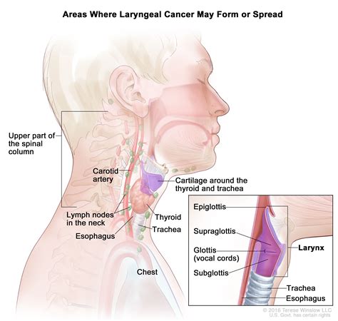 Laryngeal Cancer Treatment - NCI