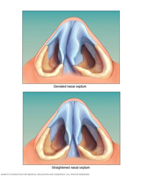 Deviated septum - Symptoms & causes - Mayo Clinic