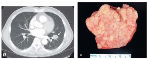 Hamartoma and Chondroma | Thoracic Key