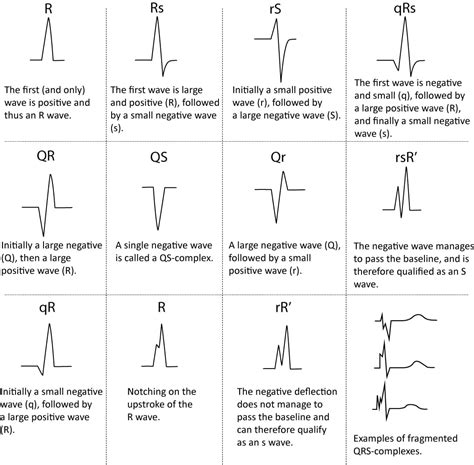 ECG interpretation: Characteristics of the normal ECG (P-wave, QRS ...