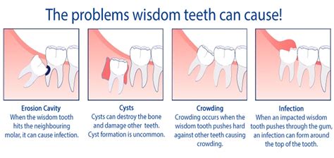 Possible Side-Effects and Complications – Wisdom Teeth Removal