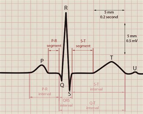 On Ecg Graph Paper An Upward Deflection Represents - Free Printable Paper