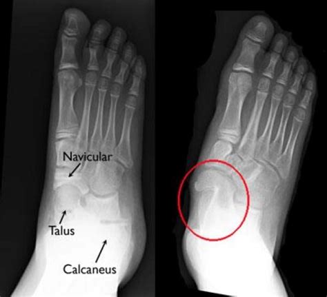 Tarsal Coalition - OrthoInfo - AAOS