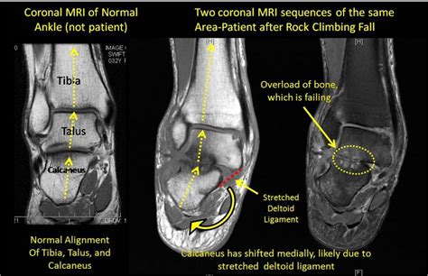 Ankle Ligament Injuries can Lead to Severe Arthritis in the Ankle