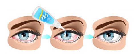 Sagging Eye Syndrome: Causes, Symptoms, Diagnosis & Treatment - Daily Medicos