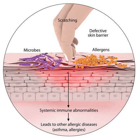 What causes Eczema or Atopic Dermatitis? | Causes of Eczema