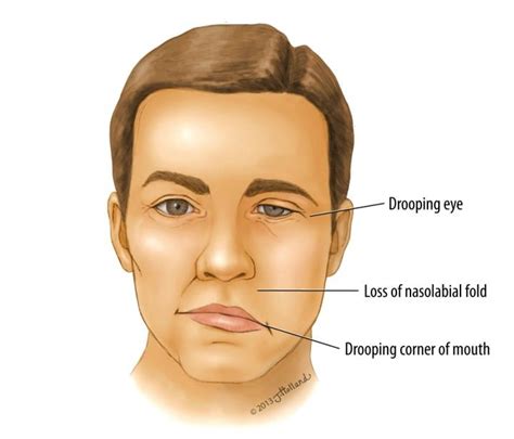 Bell’s Palsy - Symptoms, Causes And Other Risk Factors