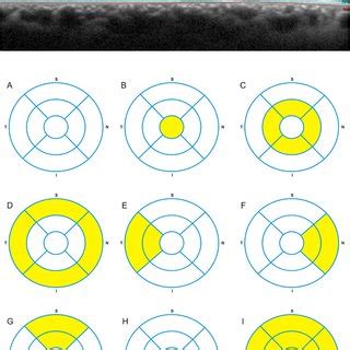 Retinal layers were identified by automatic segmentation in... | Download Scientific Diagram