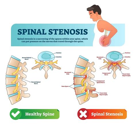 Herniated Disc vs. Spinal Stenosis: How Do They Differ?