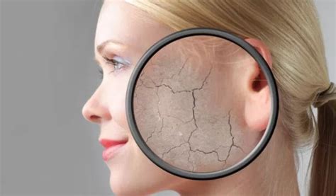 Causes, Symptoms and Treatments of Dehydrated Skin - Skincarederm