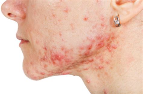 Acne on Chin: Hormonal, Cystic, Meaning and Cures | Skincarederm