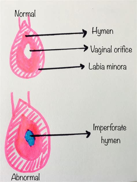 Amenorrhea made easy - Dr Tanushree Rao Women Health Blog